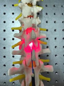 Licht-Implantat in einer Wirbelsäule zur Nervenstimulation (Illustration: birmingham.ac.uk)