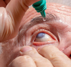 Klassische Behandlung des Grünen Stars mit Augentropfen (Foto: tcd.ie) Klassische Behandlung des Grünen Stars mit Augentropfen (Foto: tcd.ie)