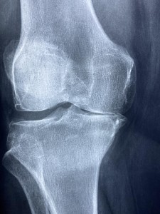 Arthritis: Ablagerungen können extrem schmerzhaft sein (Foto: pixabay.com, Manuel Gonzalez Reyes)