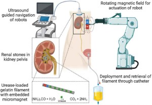 So werden Nierensteine per Roboter entschärft (Bild: UW/Advanced Healthcare Materials)