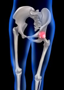Hüftprothese: bei massiven Schmerzen oft der einzige Ausweg (Foto: pixabay.com, Yoon Kwon Yi)