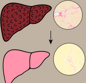 Fibrotische Leber: kann mit Henna wieder gesund werden (Illustration: omu.ac.jp) Fibrotische Leber: kann mit Henna wieder gesund werden (Illustration: omu.ac.jp)