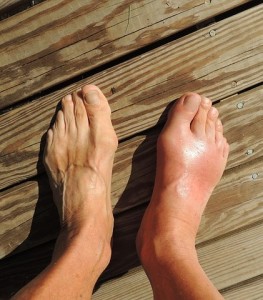 Geschwollener Fuß: Behandlung von Gicht bietet zusätzliche Vorteile (Foto: cnick, pixabay.com)