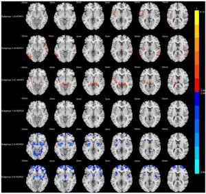 Scans: Unterschiede nachgewiesen (Foto: Tianzheng Zhong, Feng Wang, Jianfeng Qiu, Weizhao Lu)