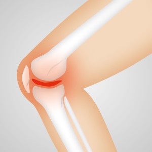 Knie: OP hilft nicht immer bei schmerzenden Gelenken (Bild: naturwohl-gesundheit, pixabay.com)