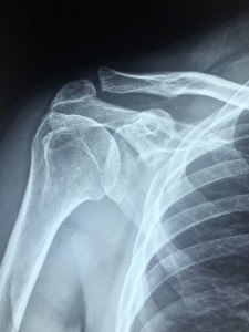 Röntgenbild: Schwere Schürzen schaden der Gesundheit (Foto: pixabay.com, Dr. Manuel Gonzalez Reyes)