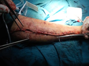 Schwere Verletzung: Gesundheitssystem gefordert (Foto: pixabay.com, WikimediaImages)