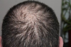 Haarverlust: lässt sich in vielen Fällen mittels Rinvoq rückgängig machen (Foto: kalhh, pixabay.com)